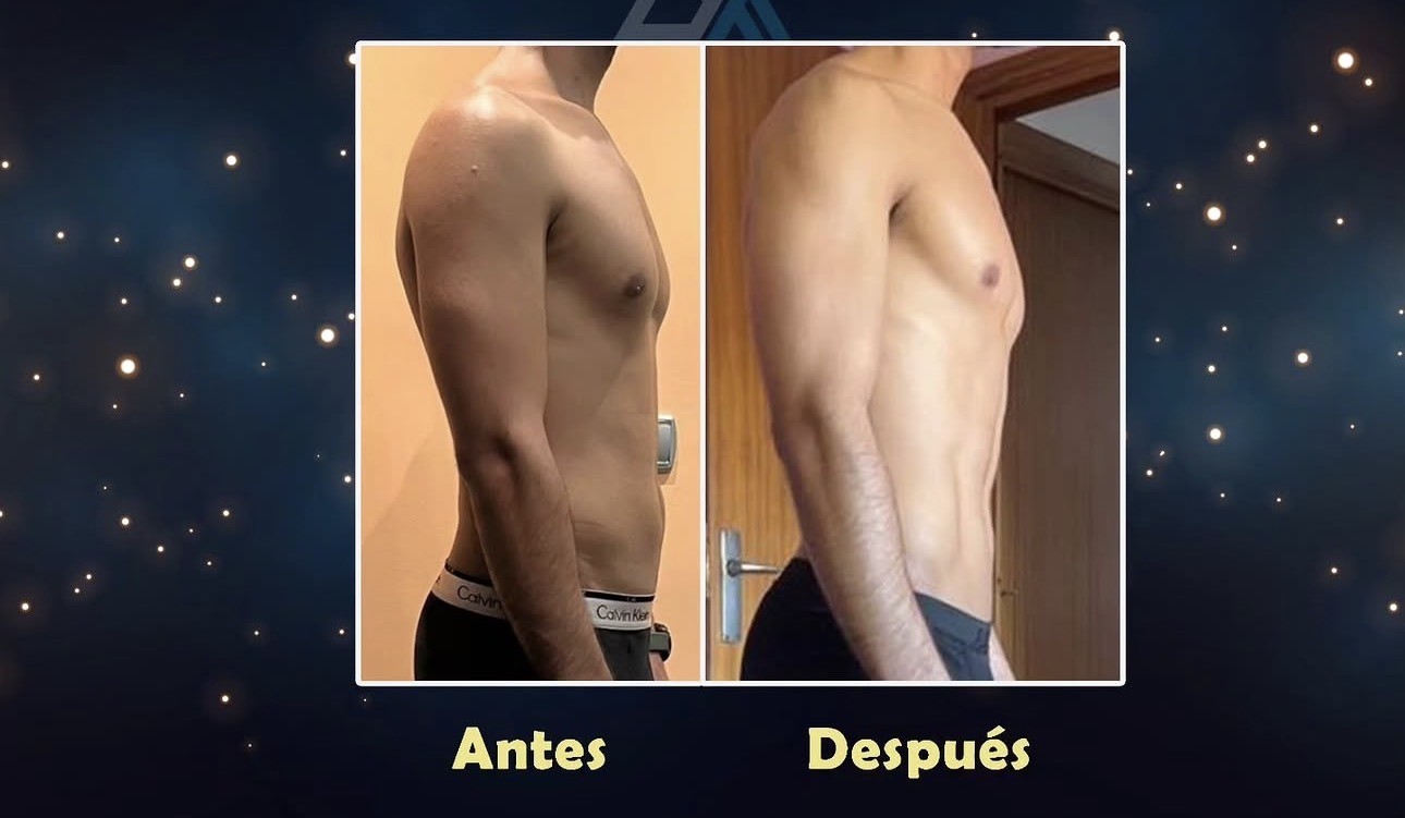 Antes y después lateral — Cliente 7
